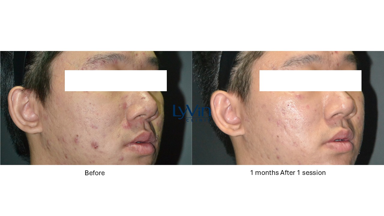 Skinvive before and after photo showing improved skin hydration and glow